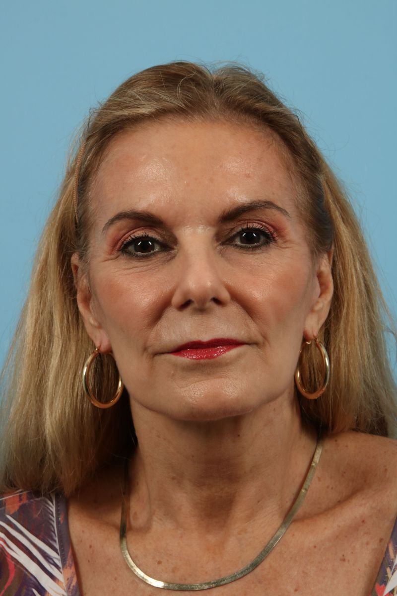 Facelifts Before & After Image