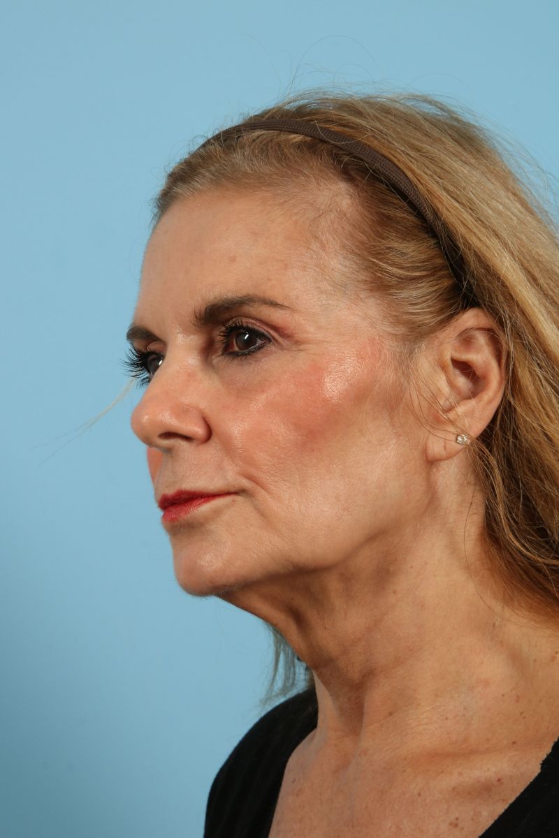 Facelifts Before & After Image