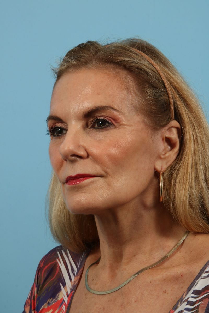 Facelifts Before & After Image