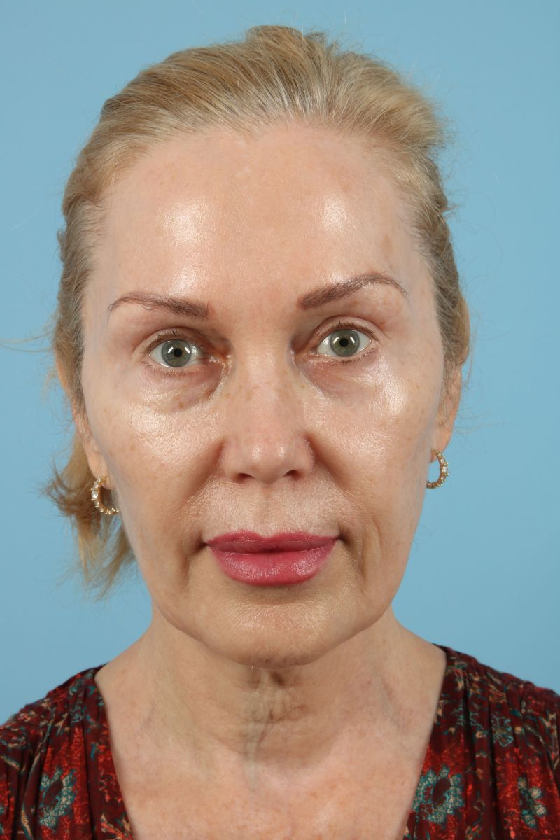 Facelifts Before & After Image