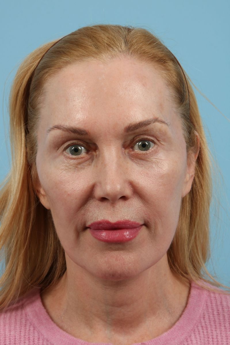 Facelifts Before & After Image