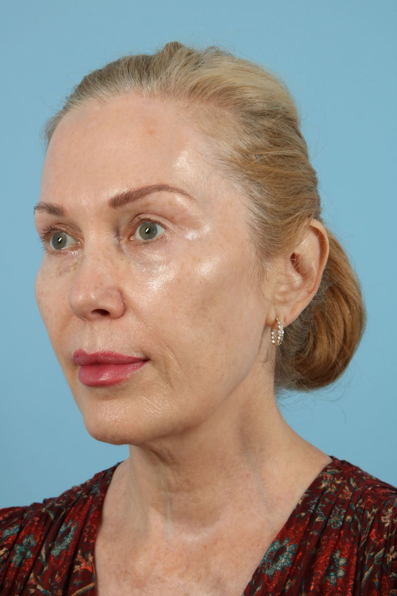 Facelifts Before & After Image