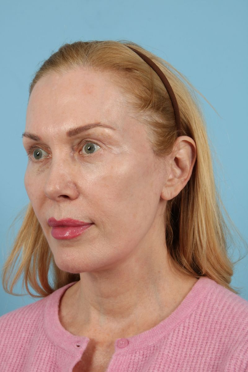 Facelifts Before & After Image