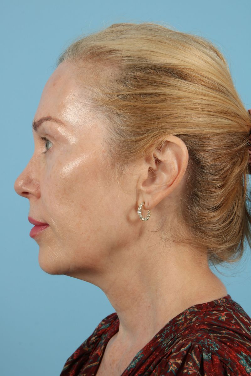 Facelifts Before & After Image