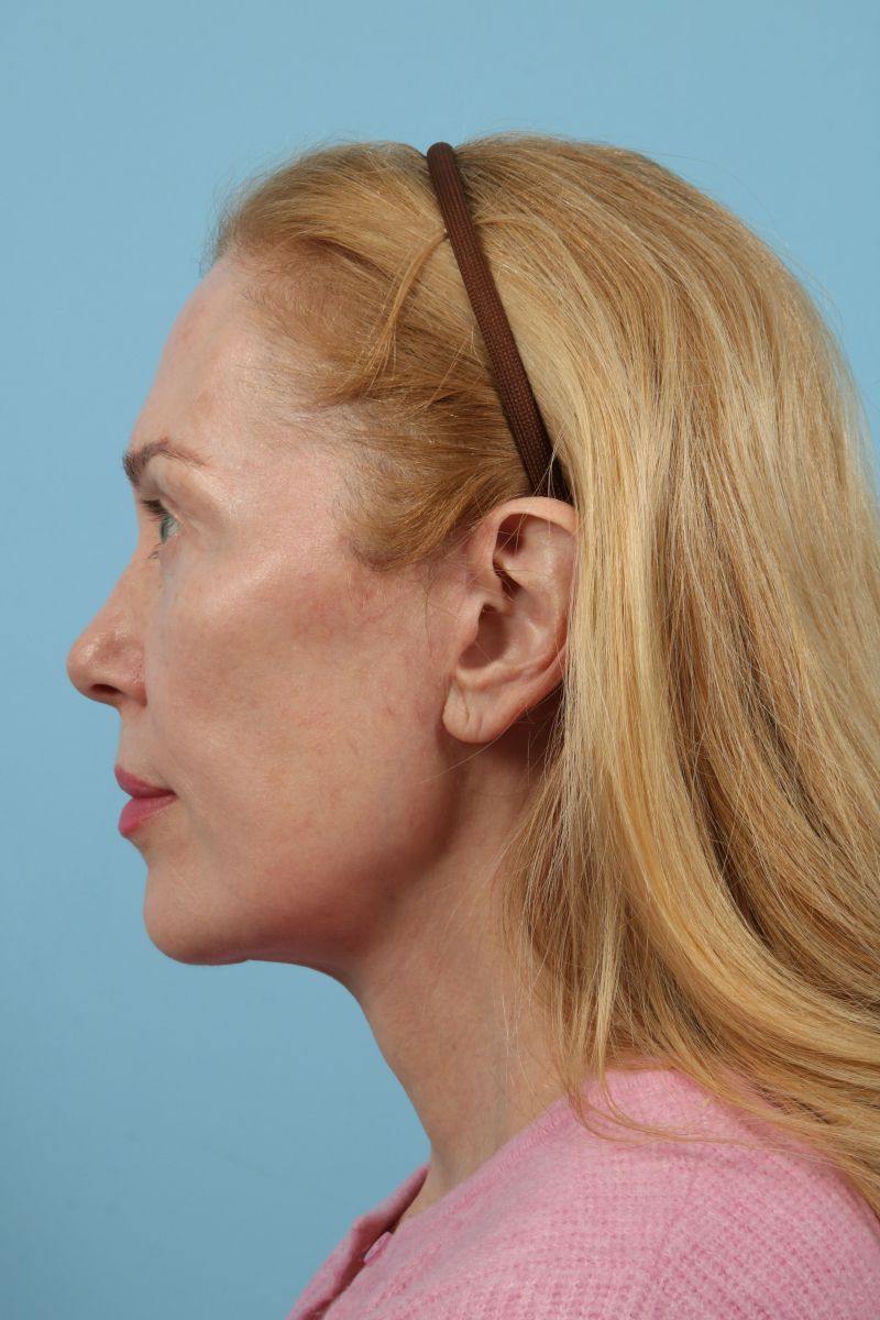 Facelifts Before & After Image