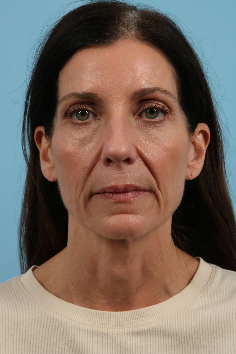 Facelifts Before & After Image