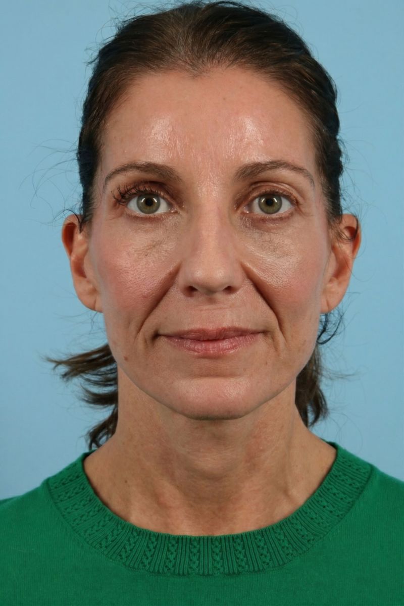 Facelifts Before & After Image