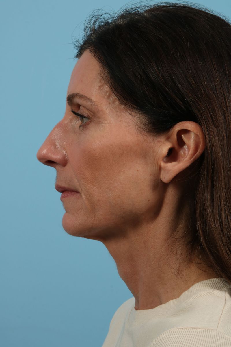 Facelifts Before & After Image