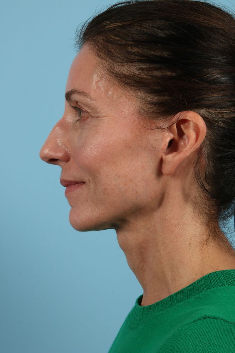 Facelifts Before & After Image