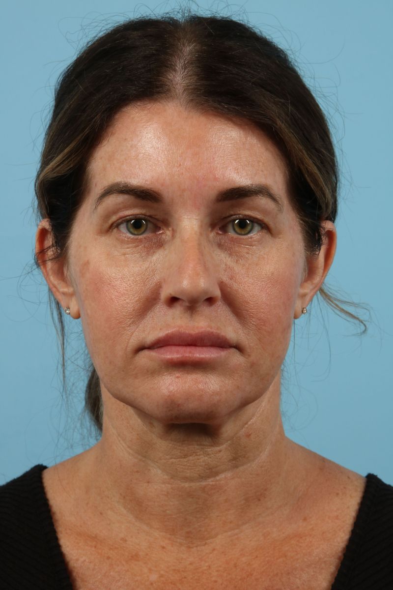 Facelifts Before & After Image