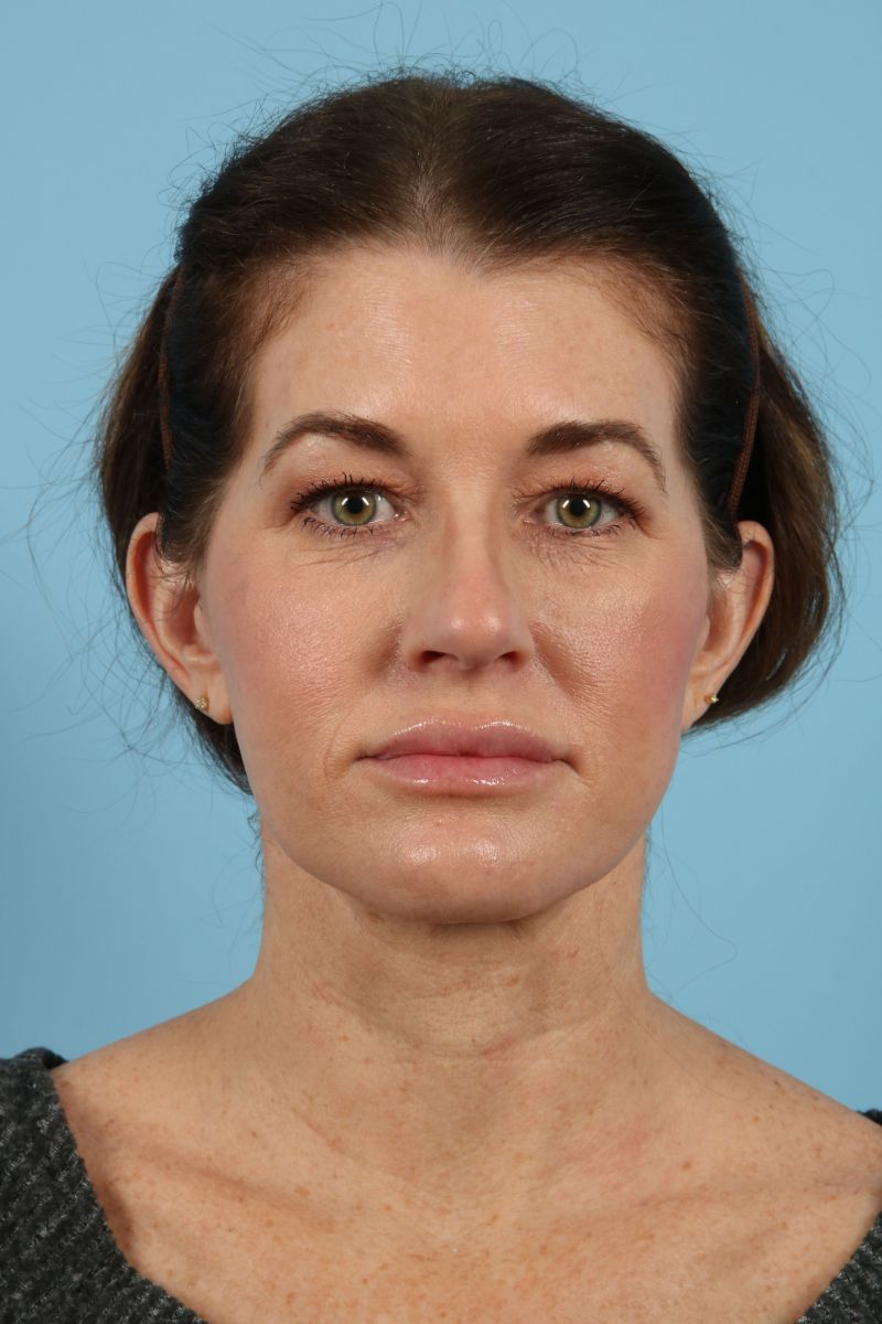 Facelifts Before & After Image