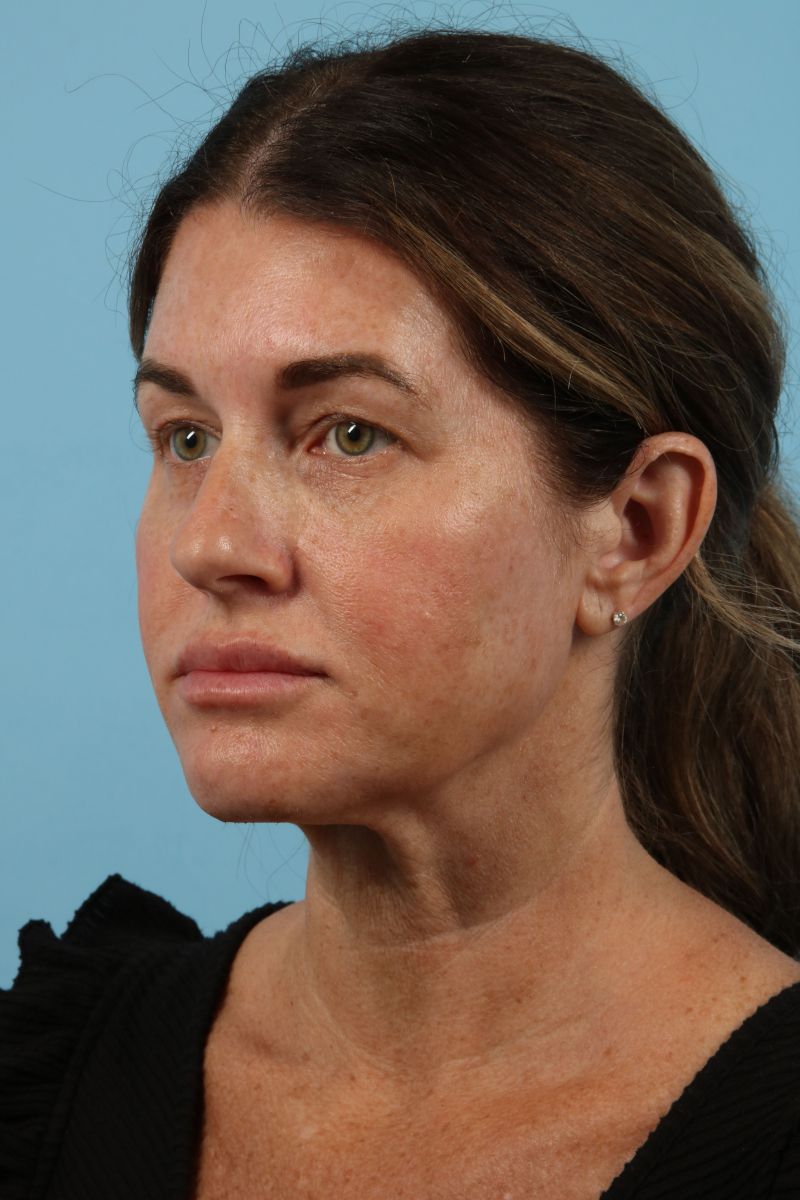 Facelifts Before & After Image