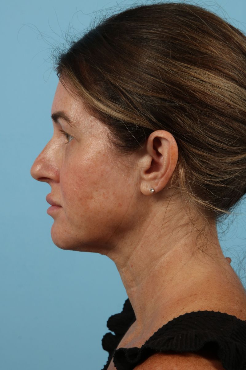 Facelifts Before & After Image