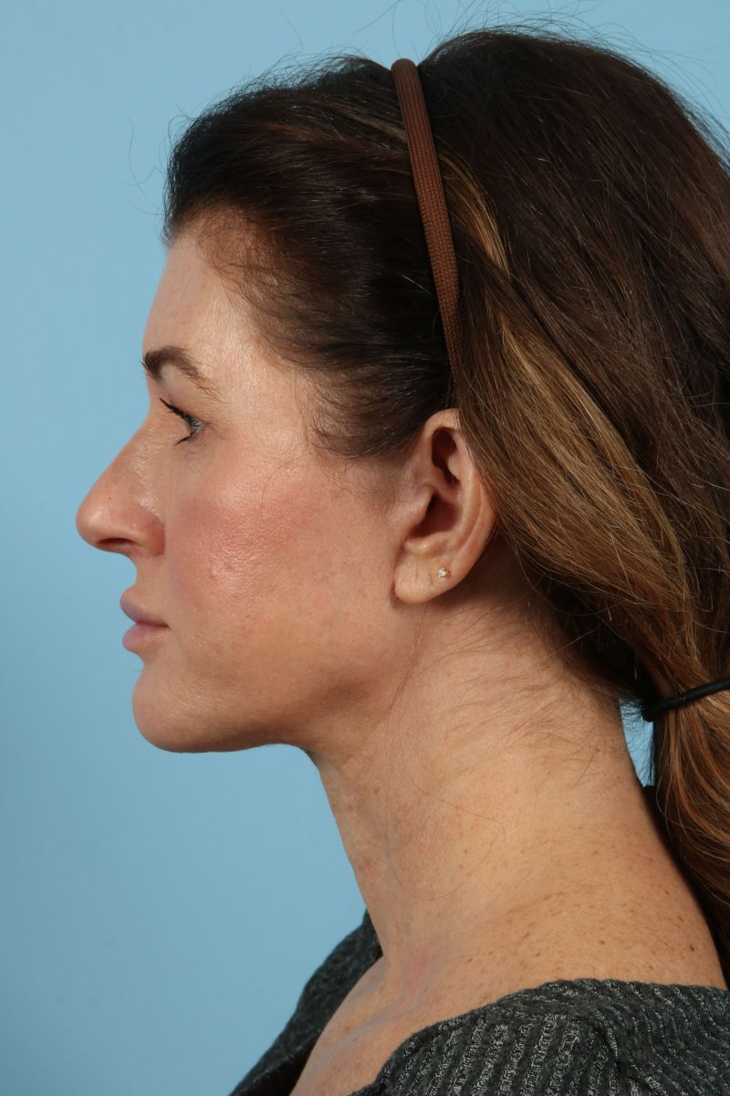 Facelifts Before & After Image