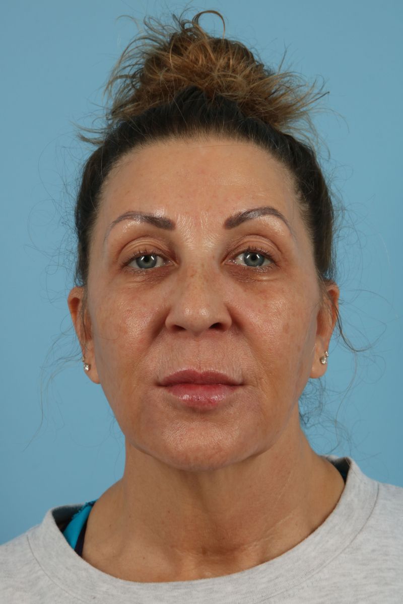 Facelifts Before & After Image