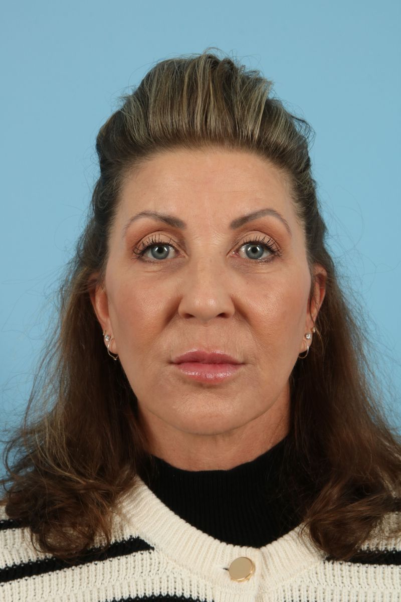 Facelifts Before & After Image