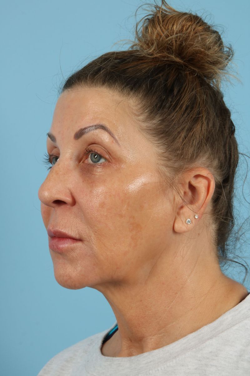 Facelifts Before & After Image