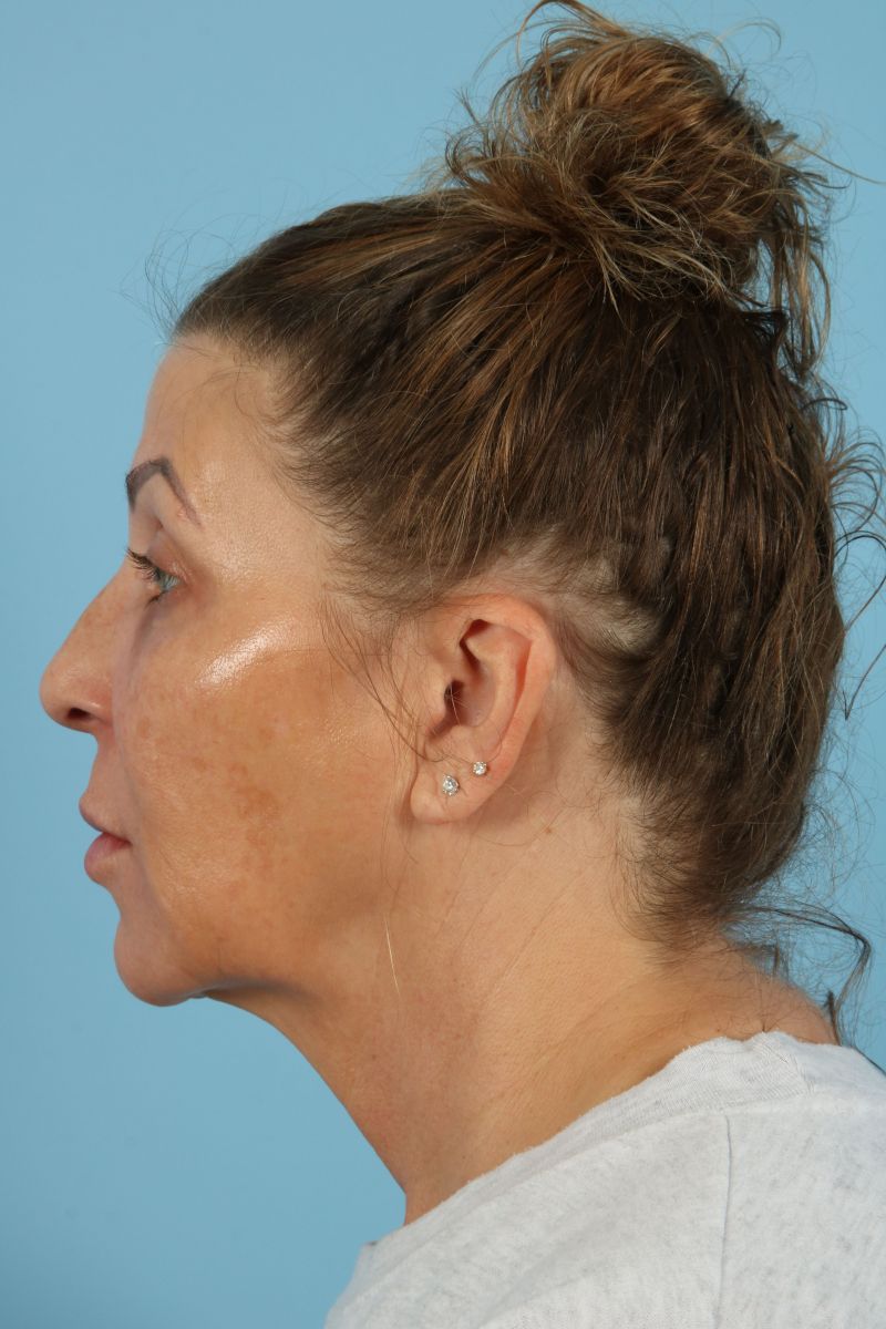 Facelifts Before & After Image