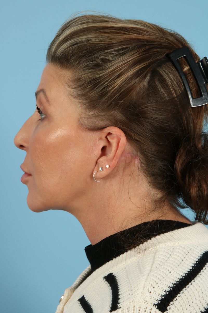 Facelifts Before & After Image