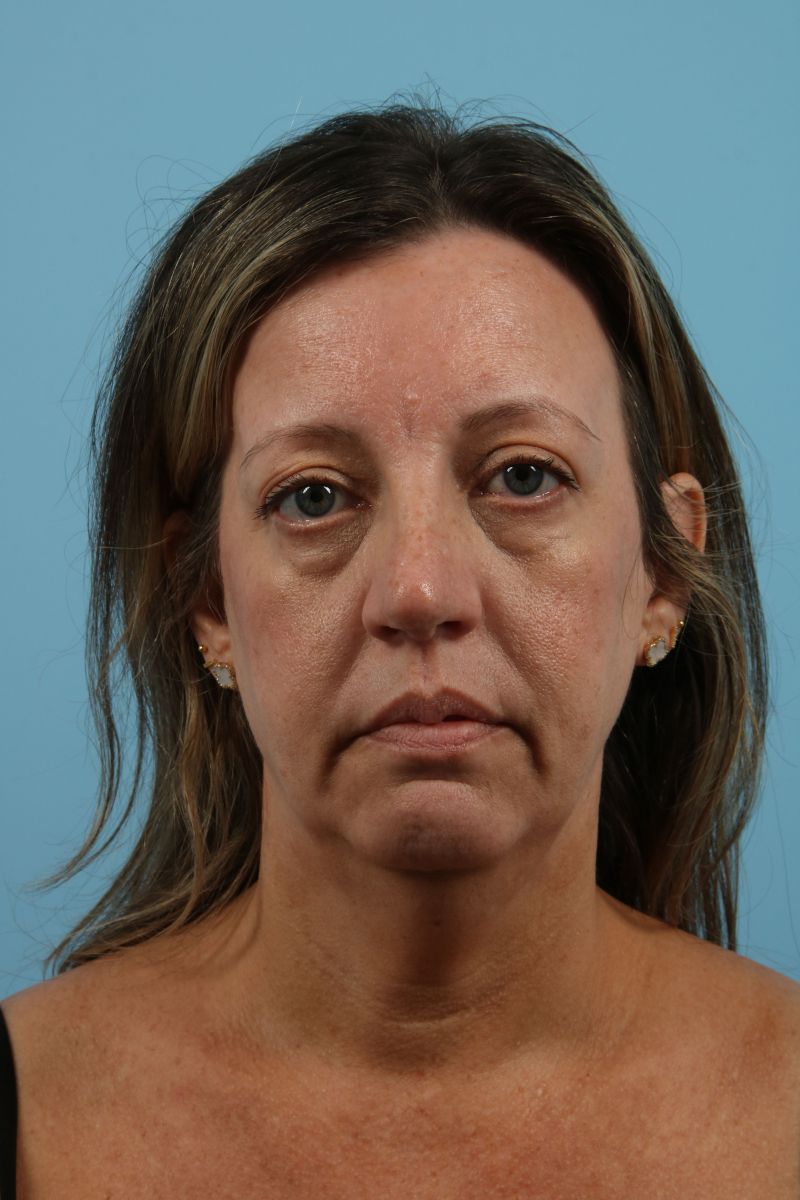 Facelifts Before & After Image