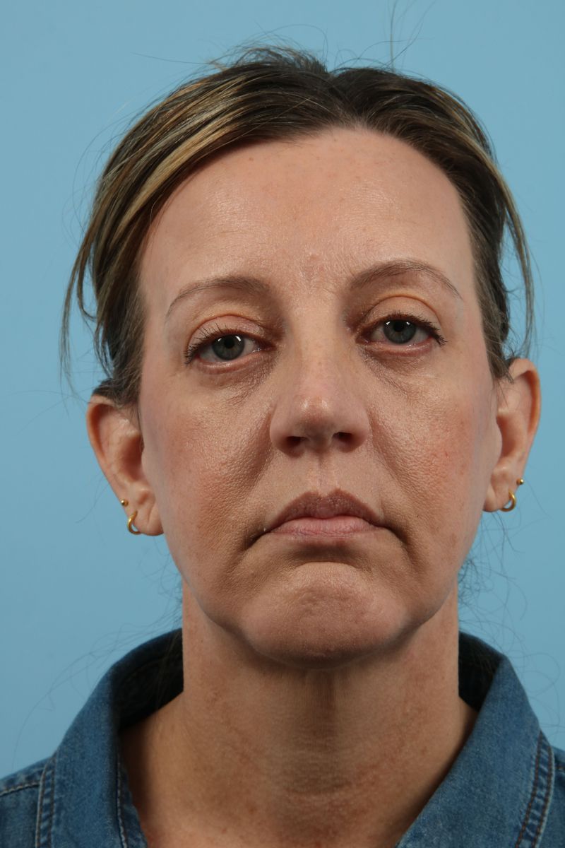 Facelifts Before & After Image