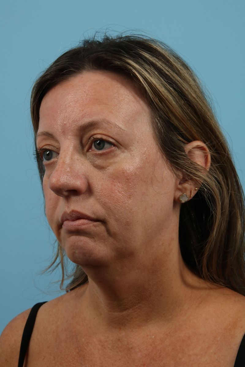 Facelifts Before & After Image