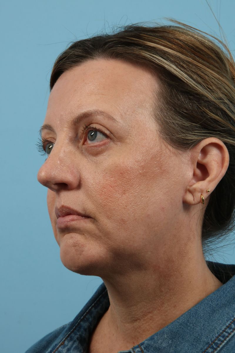 Facelifts Before & After Image