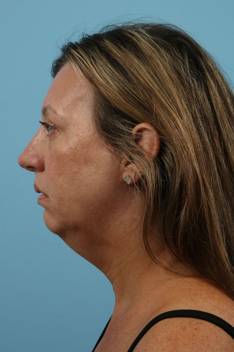 Facelifts Before & After Image