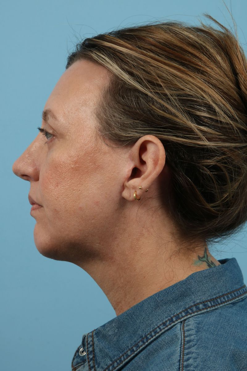 Facelifts Before & After Image