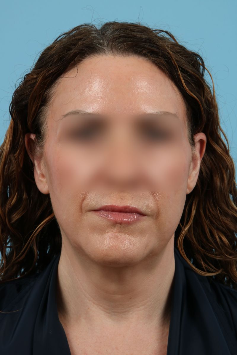 Facelifts Before & After Image