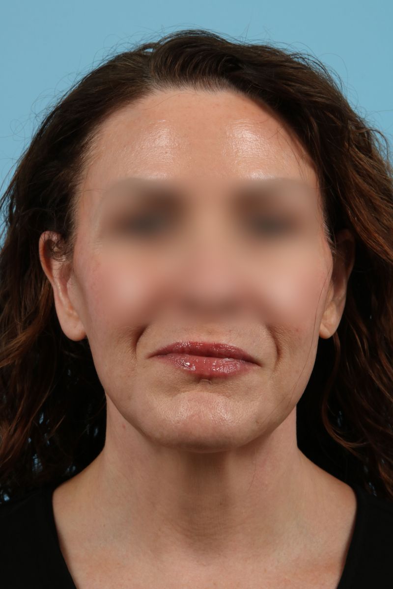 Facelifts Before & After Image