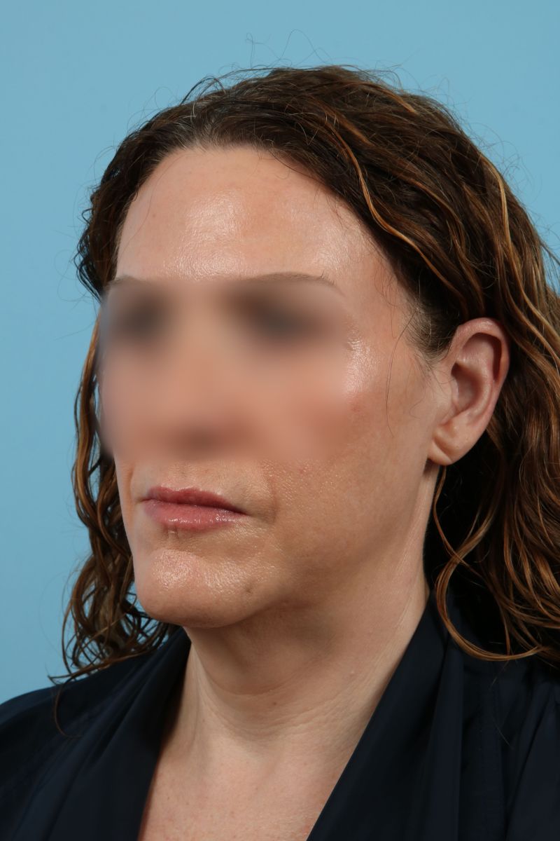 Facelifts Before & After Image