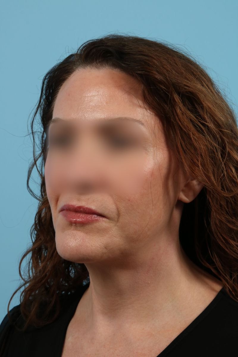 Facelifts Before & After Image