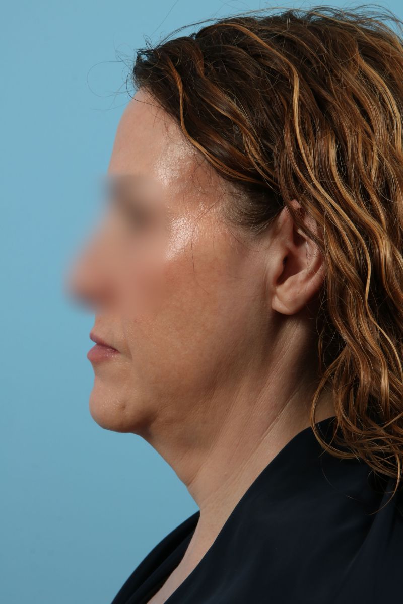 Facelifts Before & After Image