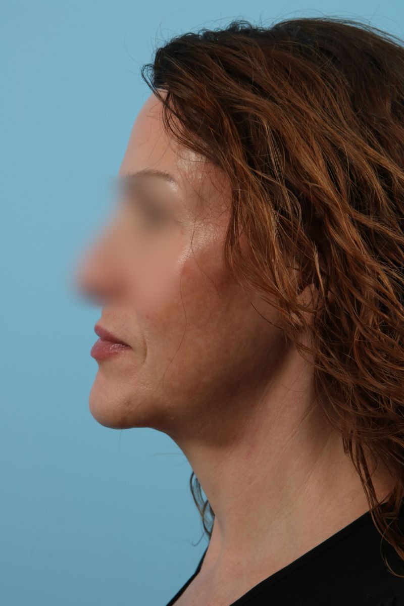 Facelifts Before & After Image