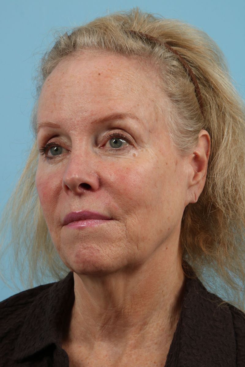 Facelifts Before & After Image