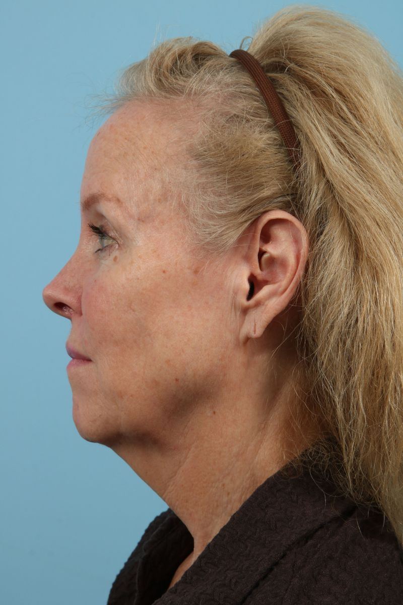 Facelifts Before & After Image