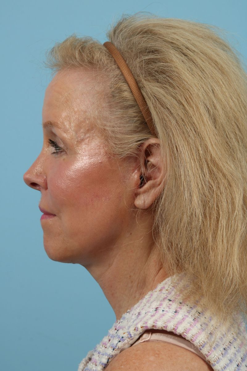 Facelifts Before & After Image