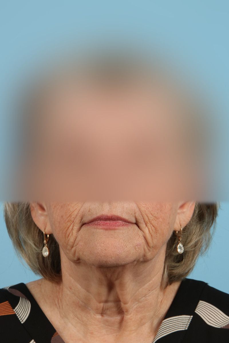 Facelifts Before & After Image