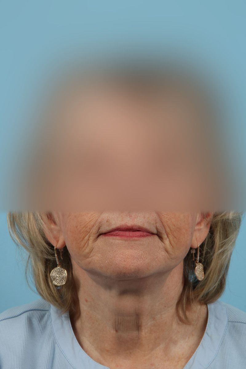 Facelifts Before & After Image