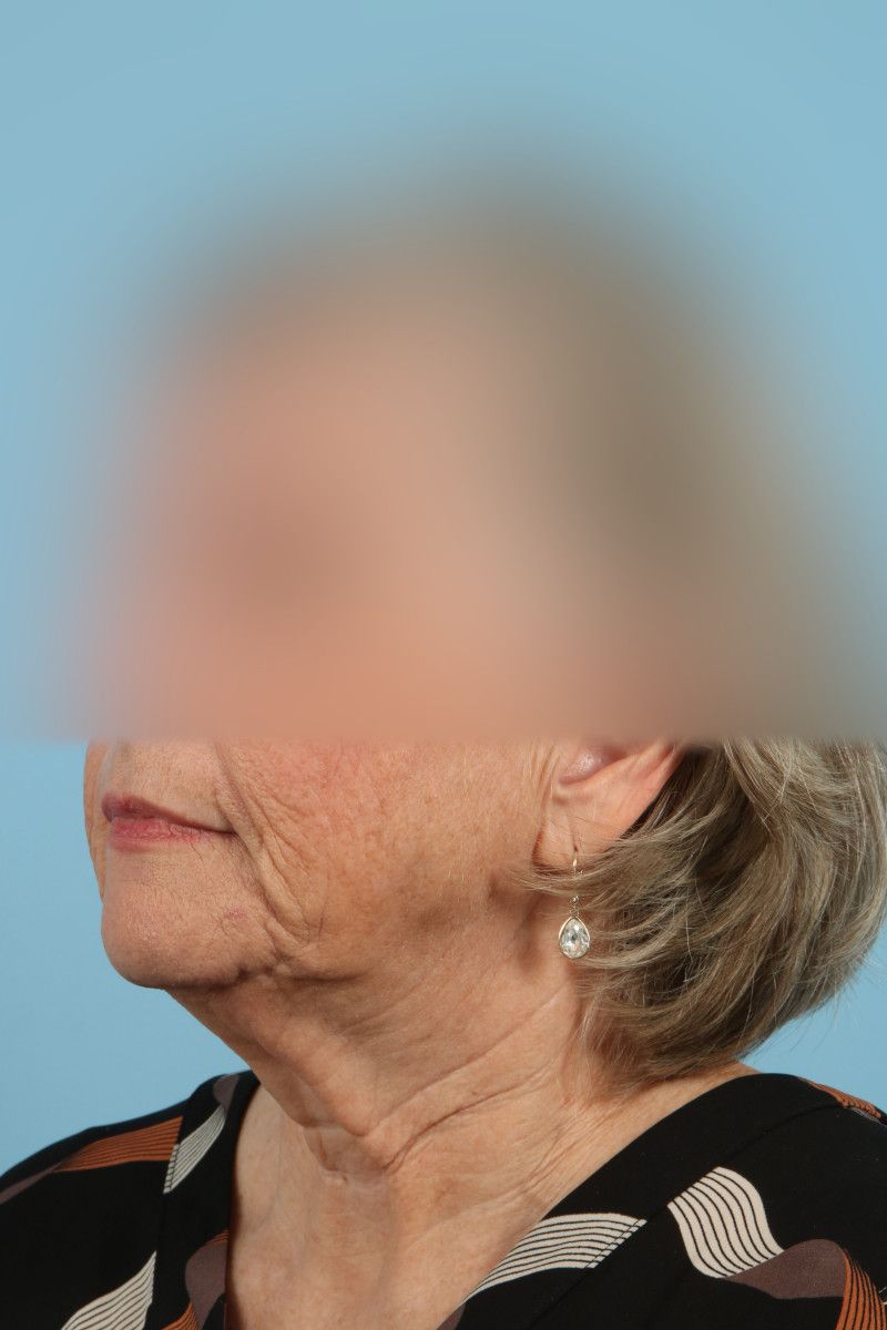 Facelifts Before & After Image