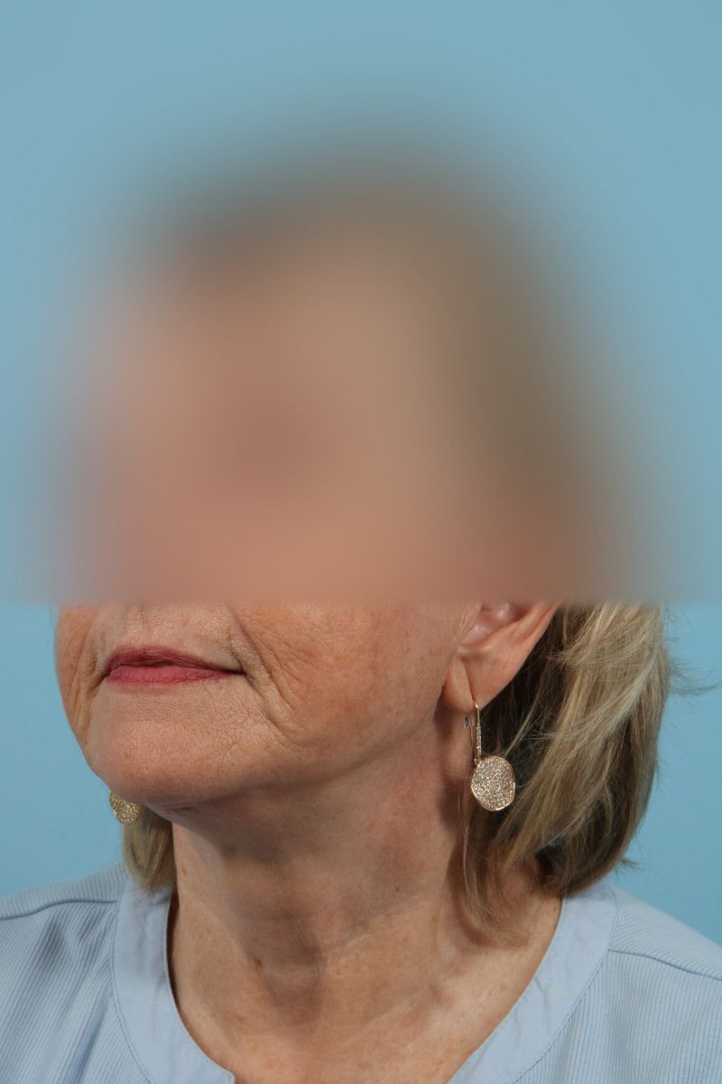 Facelifts Before & After Image
