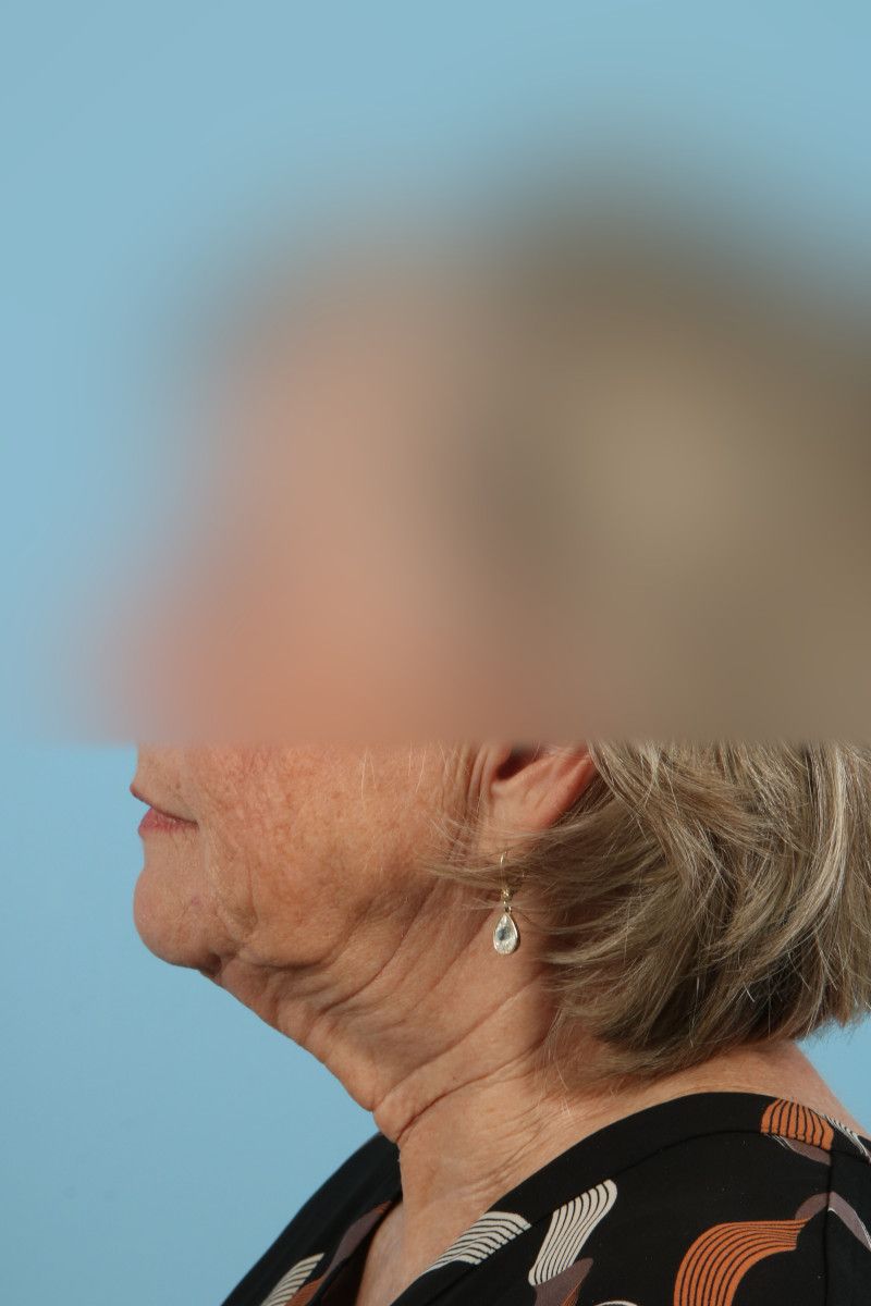 Facelifts Before & After Image