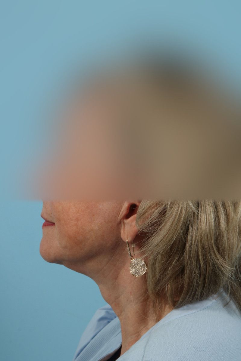 Facelifts Before & After Image