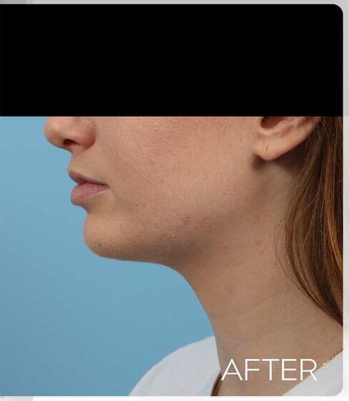 Facial Refinement Before & After Image