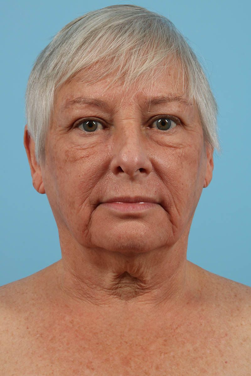 Neck Lift Before & After Image
