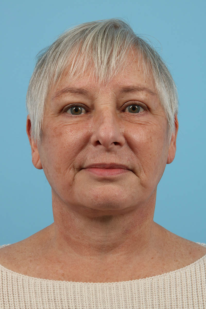 Neck Lift Before & After Image
