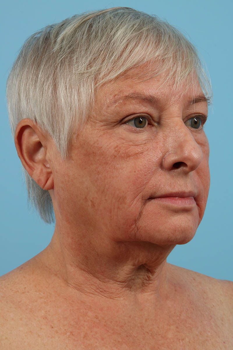 Neck Lift Before & After Image