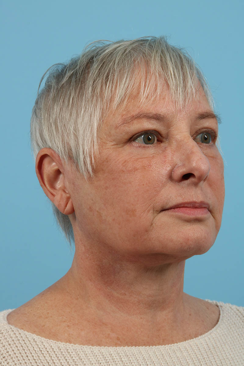 Neck Lift Before & After Image