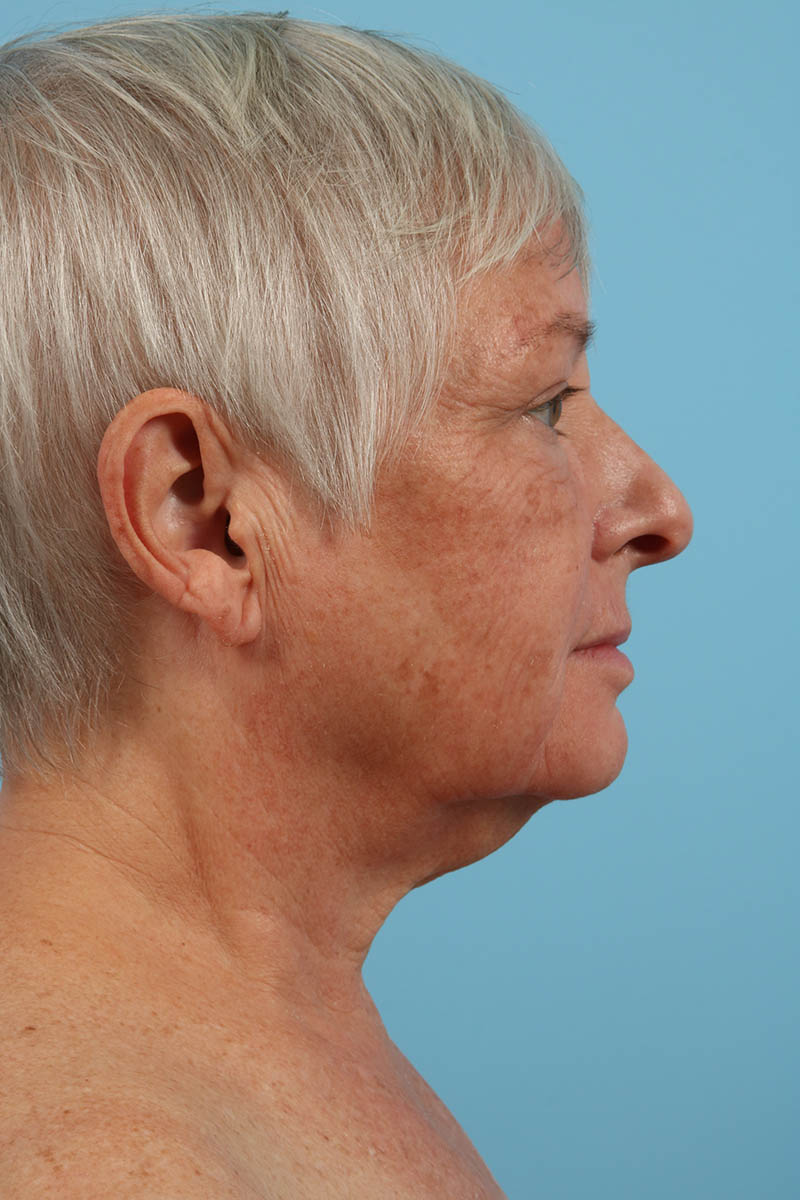 Neck Lift Before & After Image